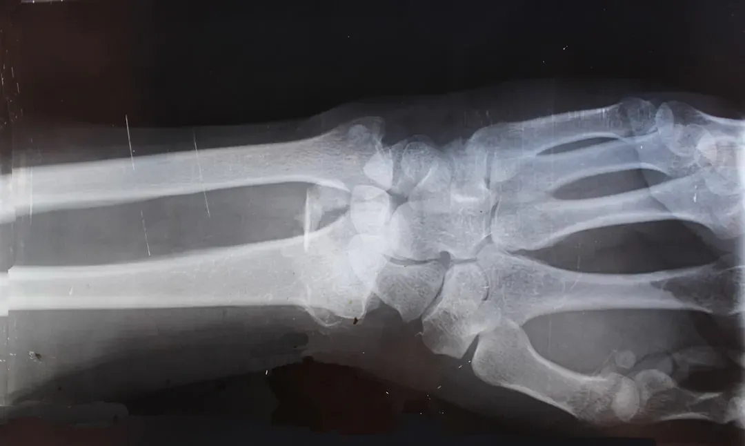 #7 - Healed Stress Fractures Riddle the Feet (Image Credits: Unsplash)