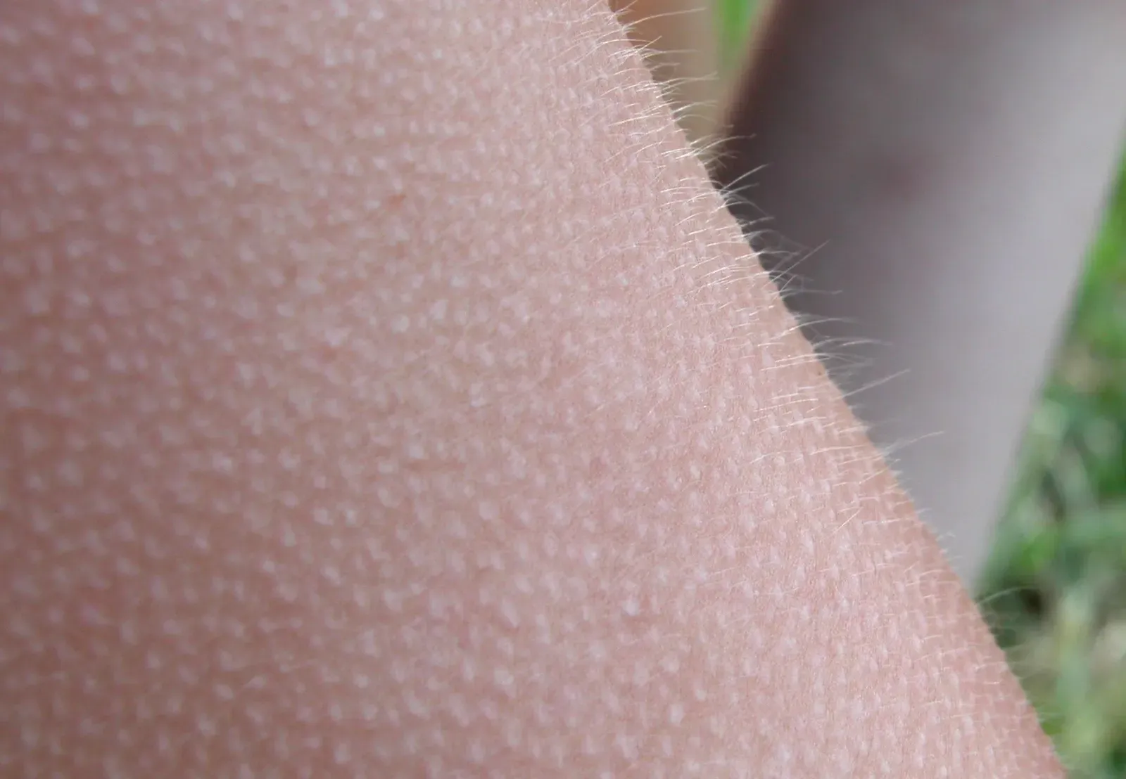 The Strange Little Muscles Behind Every Goosebump (Image Credits: Wikimedia)