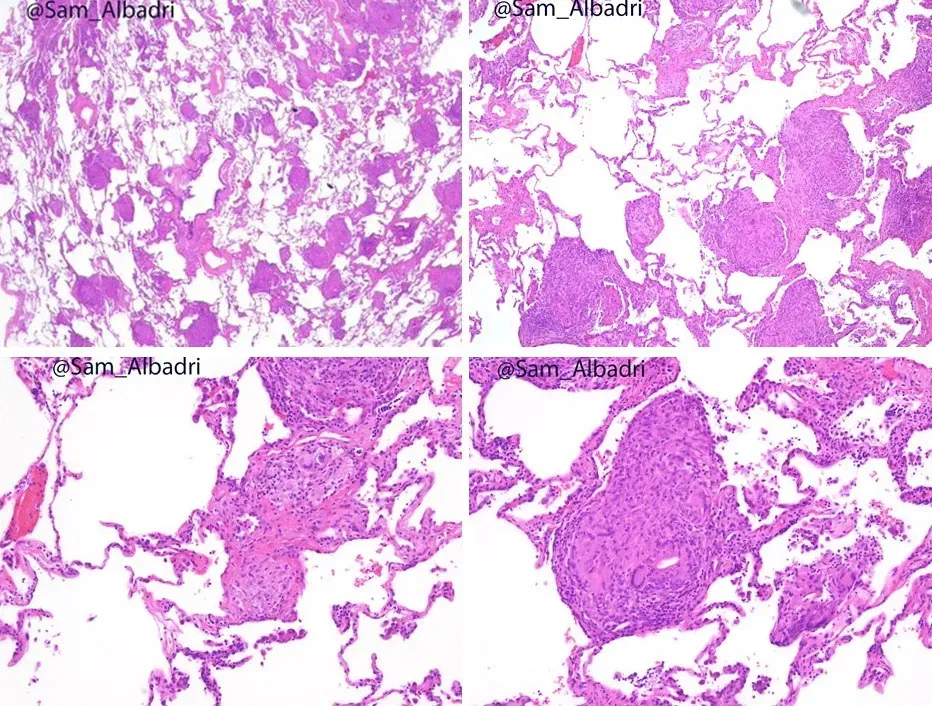 #18 A New “Organ”: The Interstitium and Hidden Structures (Pulmonary Pathology Society, Flickr, CC BY-SA 2.0)
