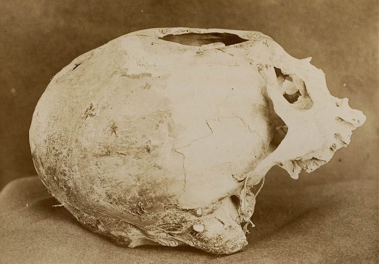 Ancient Peruvian Skull Surgery (Trepanation) (Image Credits: Wikimedia)