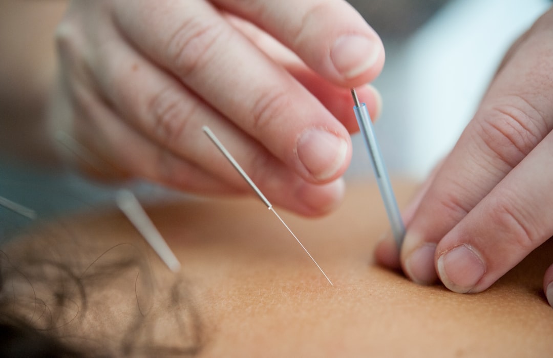 Acupuncture: Piercing Through Skepticism (Image Credits: Unsplash)