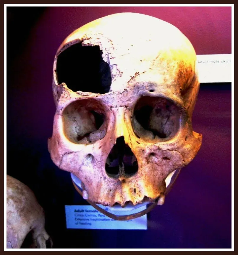 2. You’d See Brain Surgery Done With Stone Tools (Image Credits: Flickr)