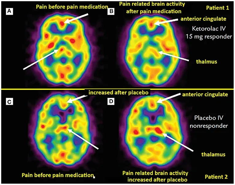 How the Brain Edits Pain: Placebos, Mindset, and Meaning (Image Credits: Wikimedia)