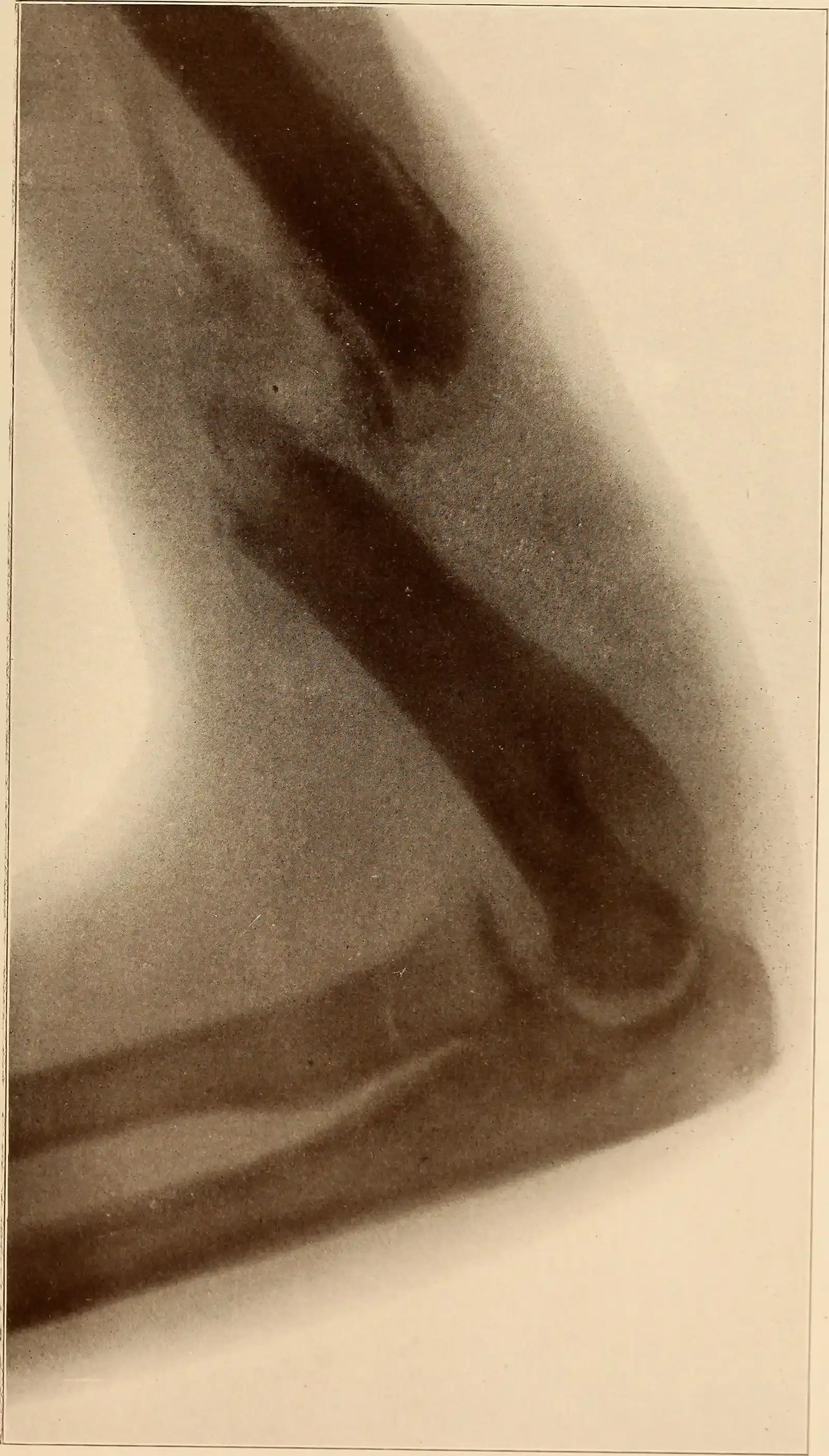 Global Challenges: Aging Populations and Fragile Skeletons (Image Credits: Wikimedia)