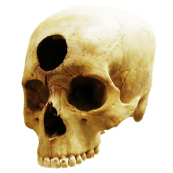5. Ancient Brain Surgery: Trepanation and Surprising Survival Rates (tsaiproject, Flickr, CC BY 2.0)