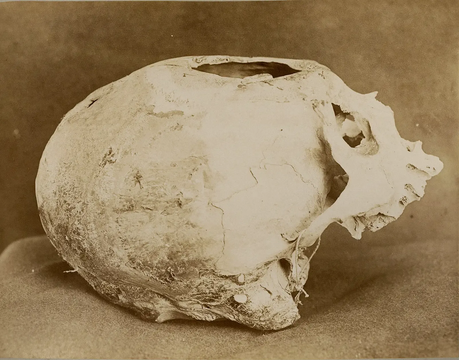 3. Skulls with Neatly Drilled Holes – That People Survived (Image Credits: Wikimedia)