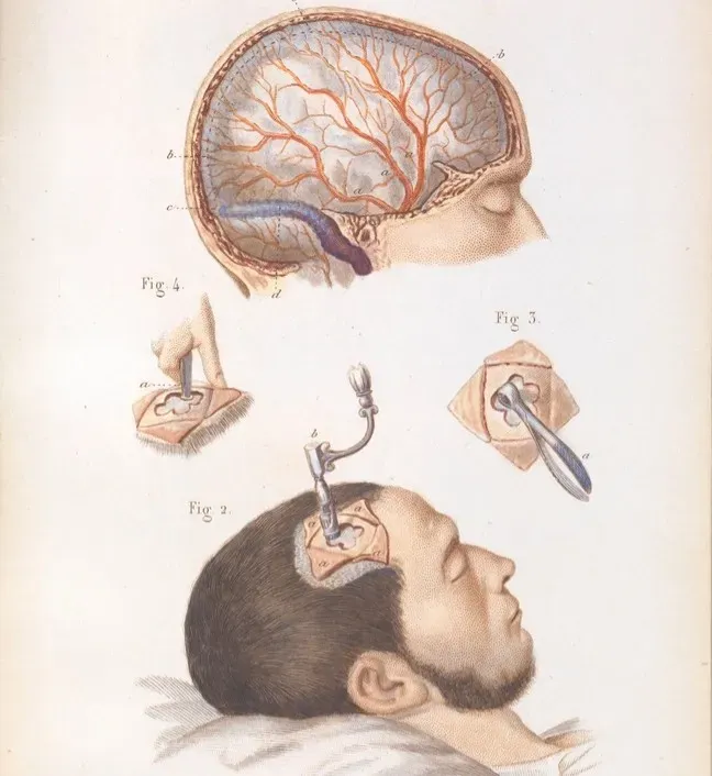 Ancient Trepanation Treatises: From Ritual Suspicions to Real Neurosurgery (Image Credits: Rawpixel)