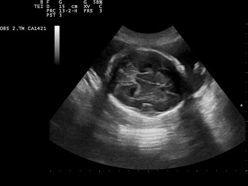 New Tools Probing Deeper Brain Regions (Image Credits: Wikimedia)