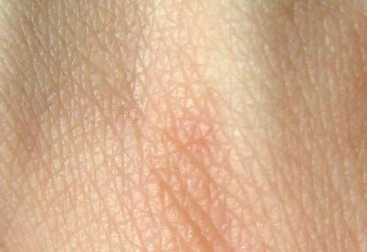 Your Skin Is Crawling With Life, and That Is a Good Thing (Image Credits: Wikimedia)