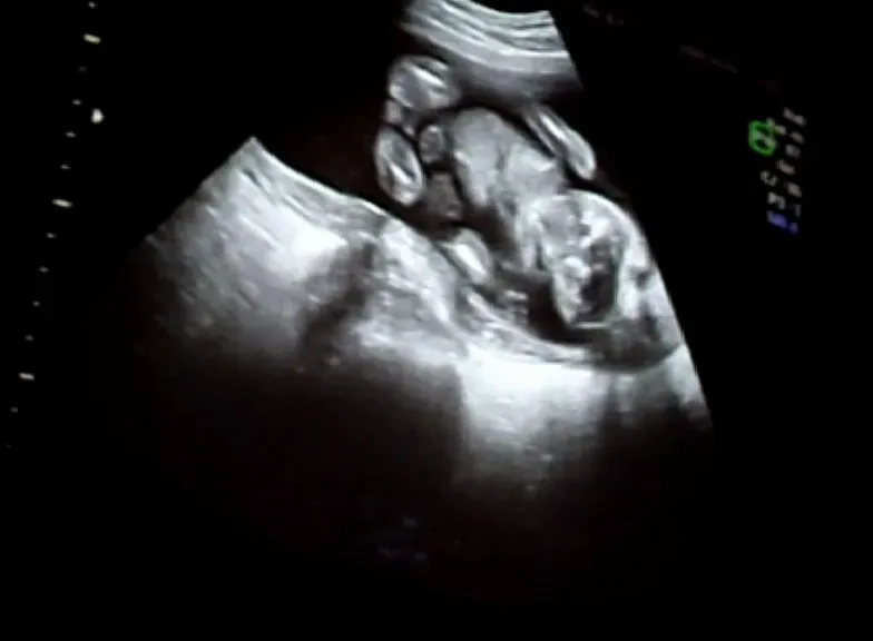 Brain Growth on a Deadline: Why the Fetus Has to Get Out (By David Nyrén, Public domain)