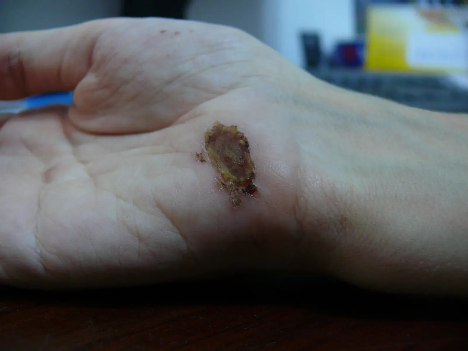 8. Frequent Infections and Slower Healing (By Arria Belli, Public domain)