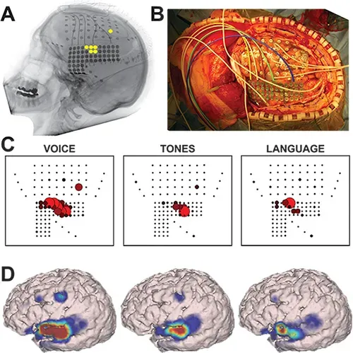 The Future Landscape: Implants, AI, and Rewriting Memory Disorders (Image Credits: Wikimedia)