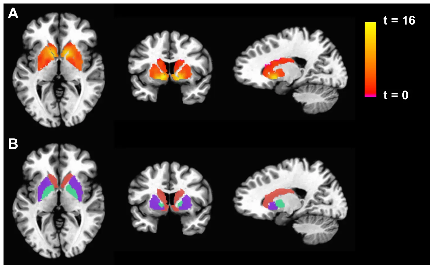 Seven Seconds of Unconscious Preparation: What Modern Brain Scanners Reveal (By Miller AH, Jones JF, Drake DF, Tian H, Unger ER, Pagnoni G (2014) Decreased Basal Ganglia Activation in Subjects with Chronic Fatigue Syndrome: Association with Symptoms of Fatigue. PLoS ONE 9(5): e98156. doi:10.1371/journal.pone.0098156, CC BY 4.0)