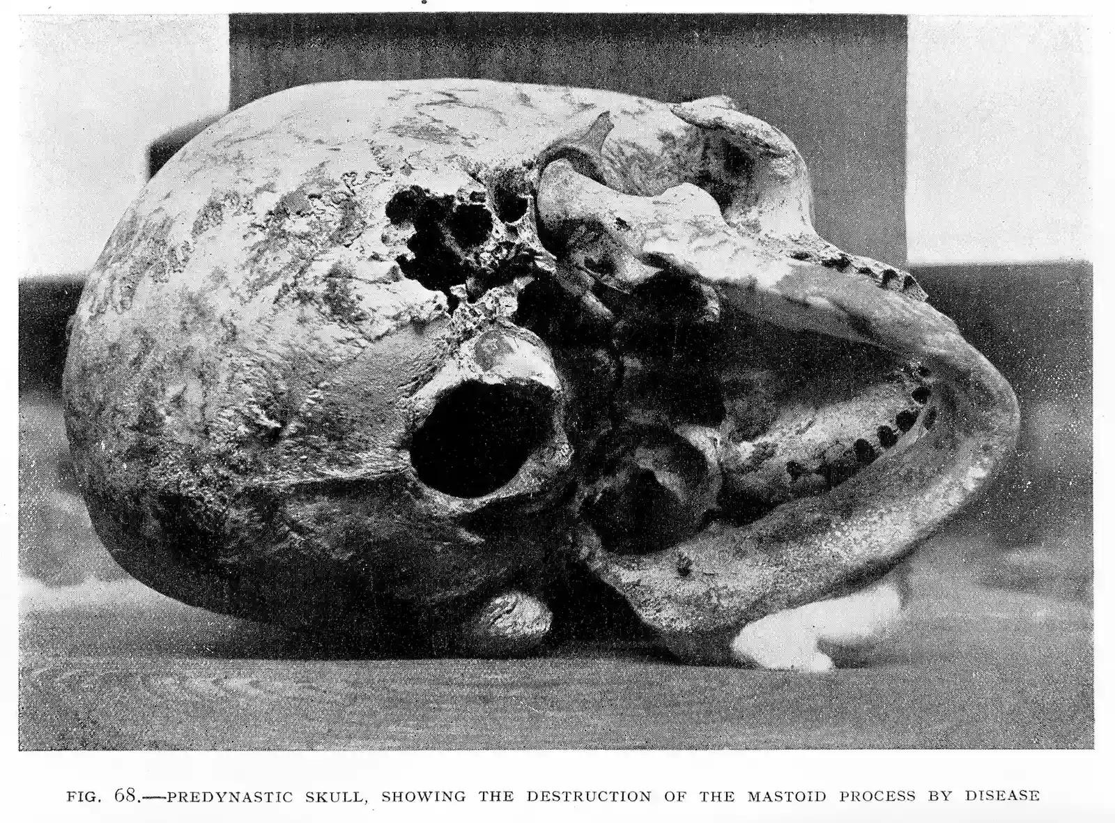 Ancient Cancer Surgery Evidence on a 4,500-Year-Old Skull (Image Credits: Wikimedia)