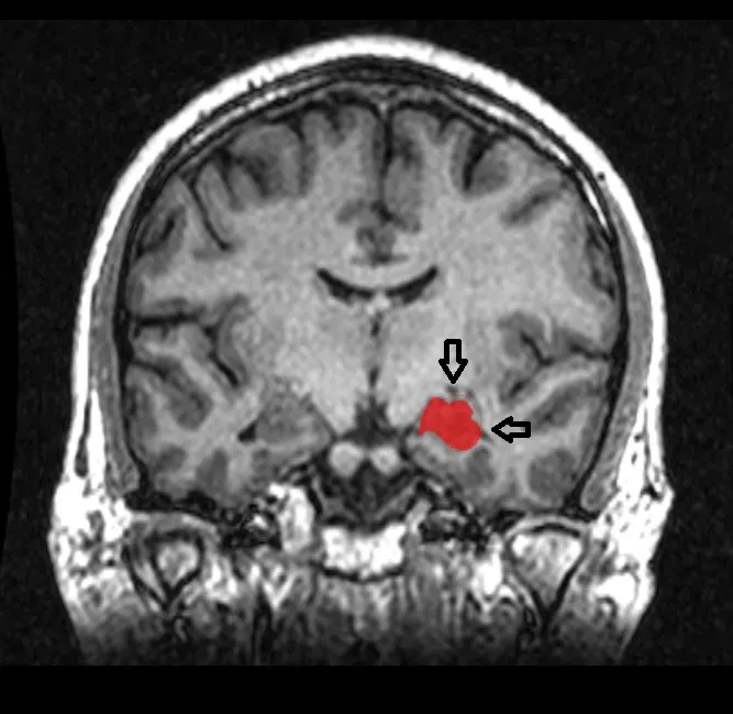 The Hidden Clues: How the Brain Files Emotional Pain (Image Credits: Wikimedia)