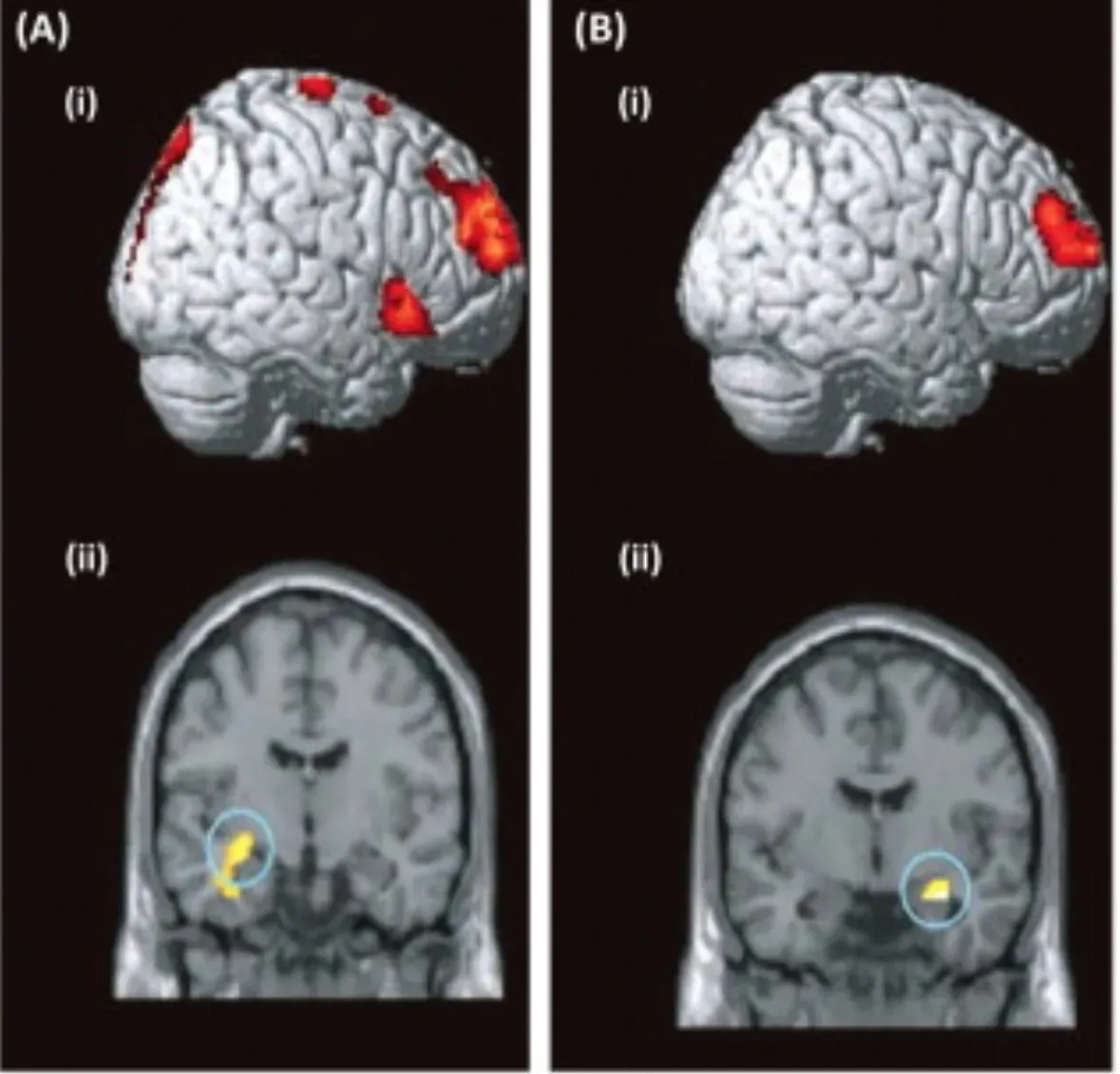 How Brain Imaging Turned Thought Into a “Yes” or “No” Signal (By Micheal C Anderson, Simon Hanslmayr, CC BY 3.0)