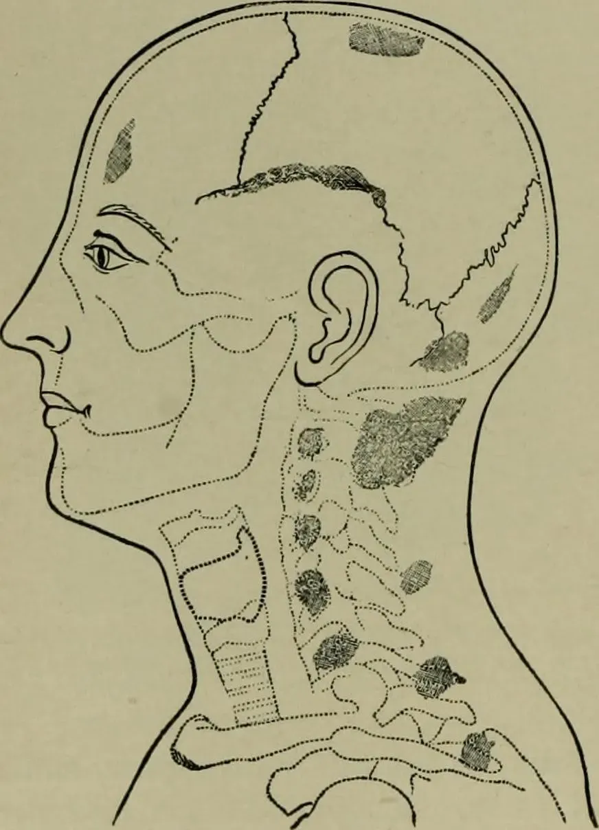 Fibromyalgia and Chronic Pain: When the Nervous System Becomes a Black Box (Image Credits: Wikimedia)