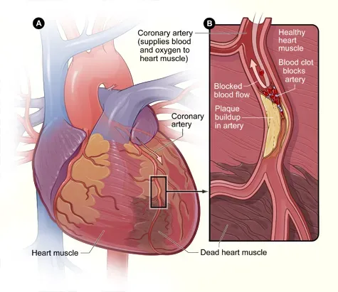 Coronary Artery Disease: Slowly Starving Your Heart Of Oxygen (National Heart Lung and Blood Institute (NIH), Public domain)