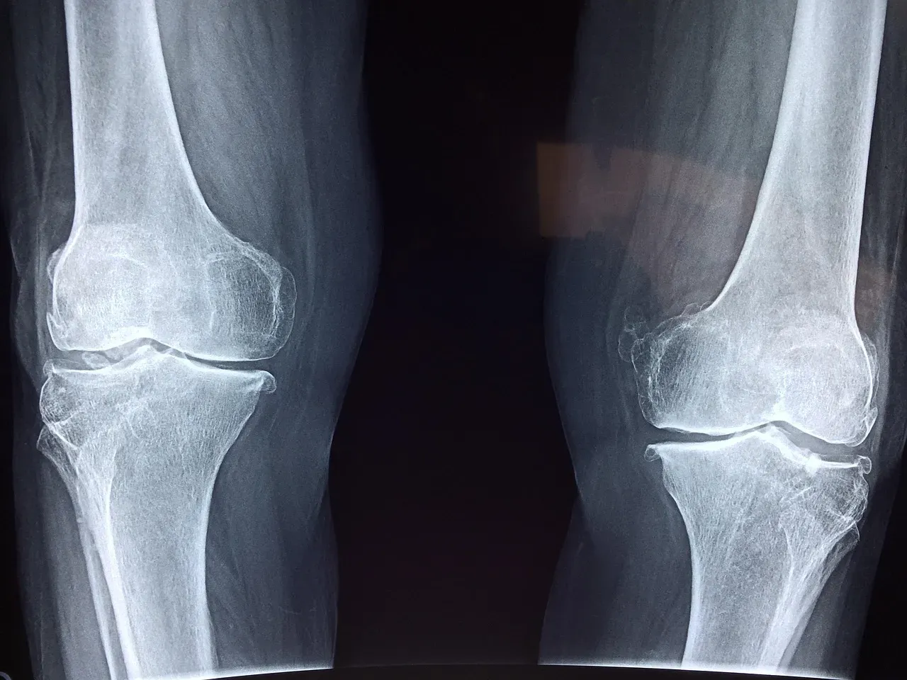 Calcium and Vitamin D: The Bone Health Balancing Act (Image Credits: Pixabay)