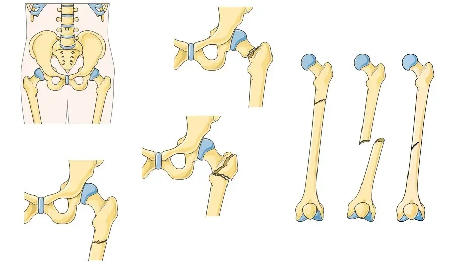 8. Weak Bones and Increasing Fracture Risk (By Servier Medical Art, CC BY-SA 3.0)