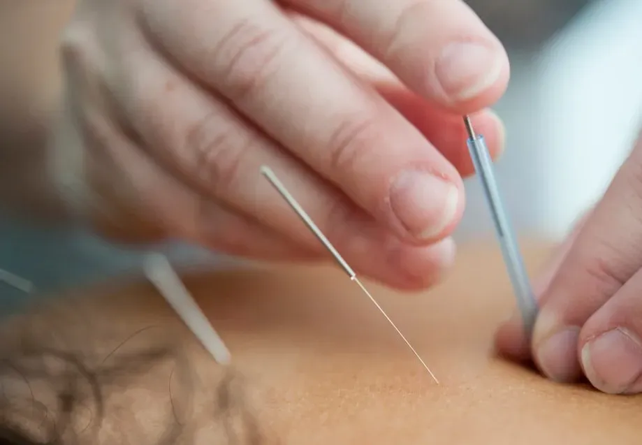 Acupuncture for Pain Management (Image Credits: Unsplash)