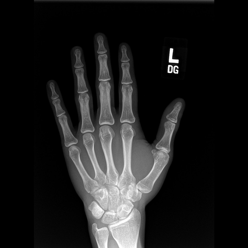 X-rays: A Glowing Accident Unveiled the Invisible (image credits: flickr)
