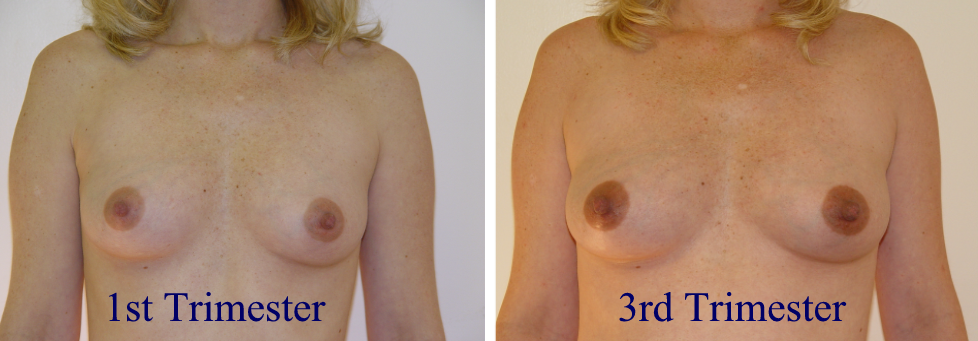 Subtle Breast Changes Beyond Basic Tenderness (image credits: wikimedia)