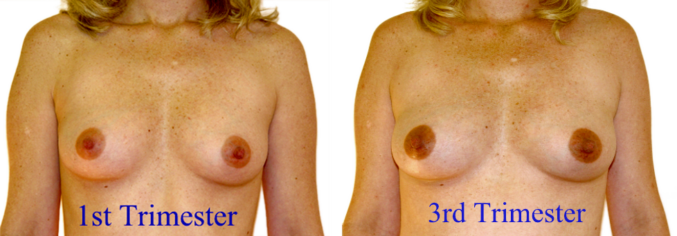 Breast Changes That Nobody Talks About (image credits: wikimedia)
