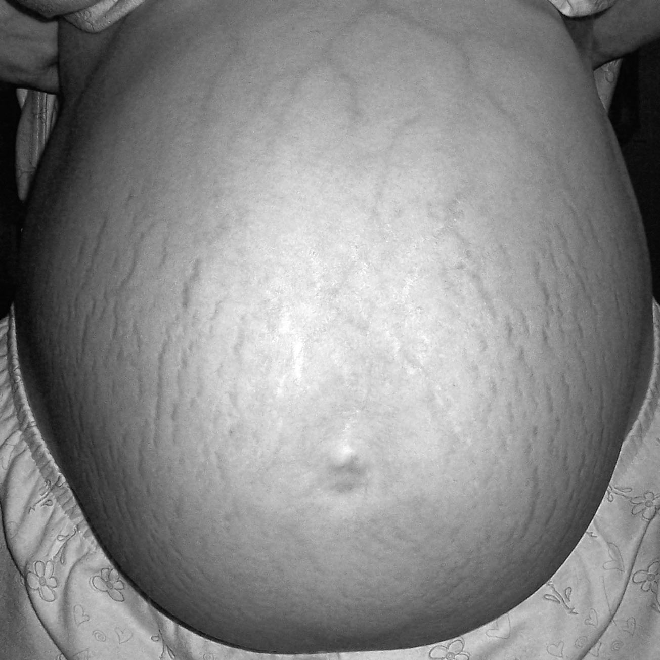 Stretch Marks Can Be Prevented With Creams (image credits: wikimedia)