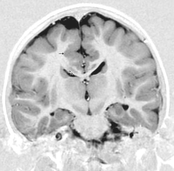 Physical Brain Changes Linked to Screen Use (image credits: wikimedia)