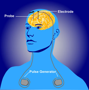How the Brain Changes During Exposure (image credits: wikimedia)