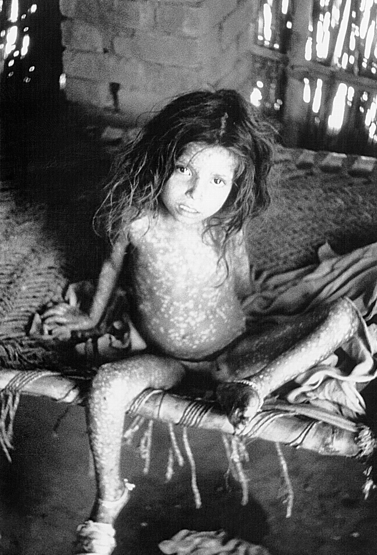 The Deadliest Killer in History: Smallpox Devastated the World (image credits: wikimedia)