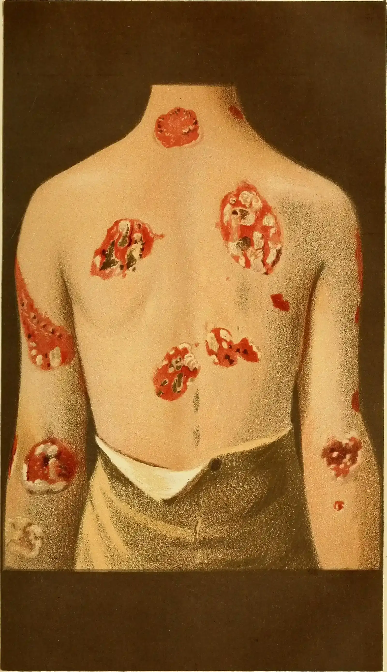 11. The Syphilis Outbreak of the Renaissance Was Essentially a Real Zombie Plague (By Cooper, Alfred, Sir, 1846-1908;

Cotterell, Edward, 1857-1898, No restrictions)
