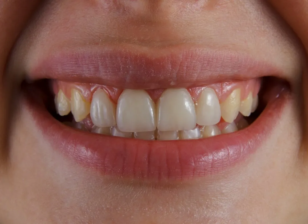 What Actually Happens to Enamel After You Drink Coffee (Image Credits: Unsplash)