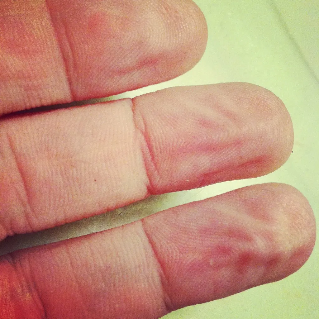 Why Only Fingers and Toes, Not Your Arms or Back (savanna-smiles, Flickr, CC BY-SA 2.0)