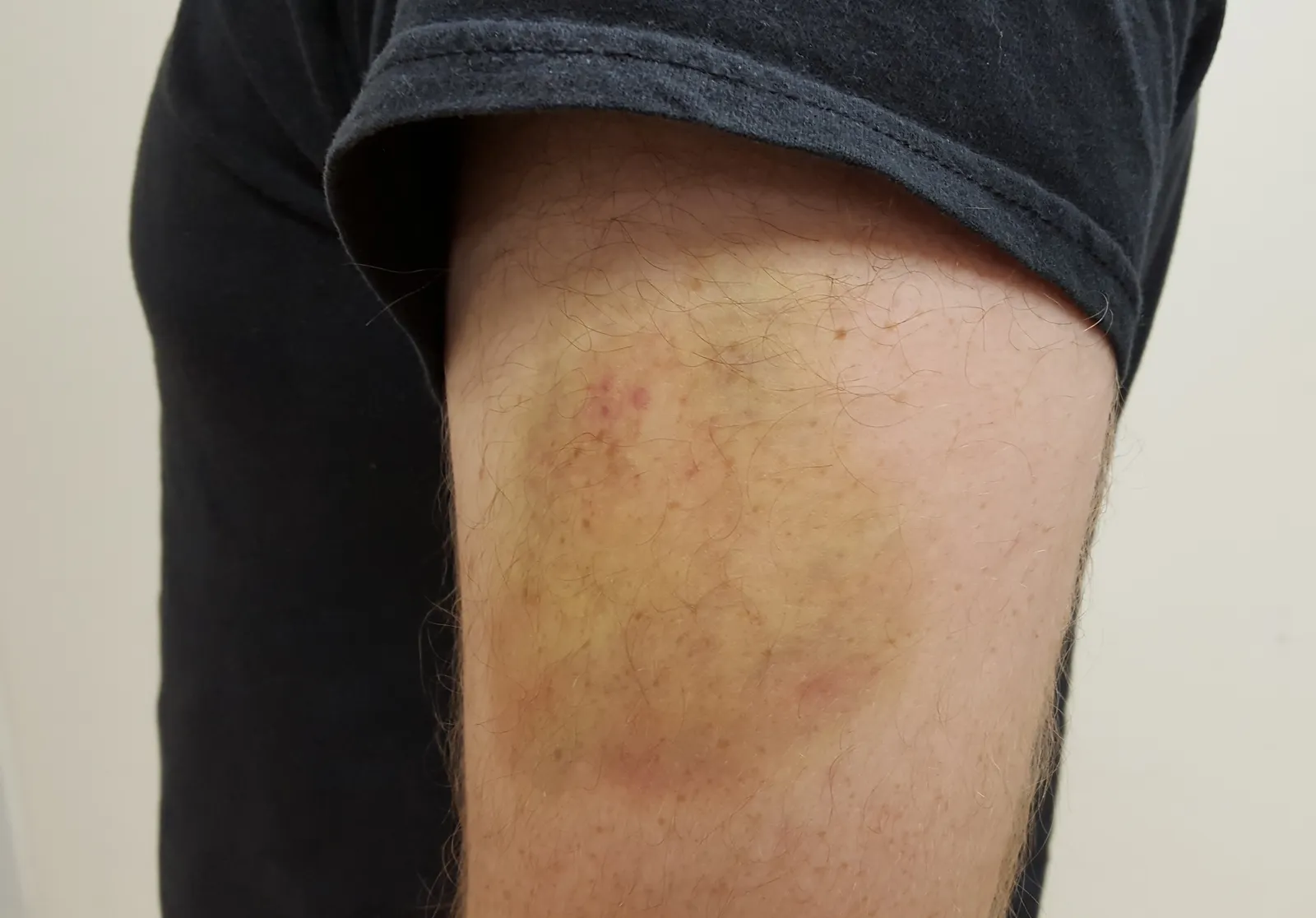 Bruising That Shouldn't Be Ignored (Taken with my Galaxy S6 camerphone
Previously published: Never before published, CC BY-SA 3.0)