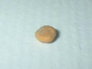 The Kidney Stone Connection (Daybrightener, Flickr, CC BY 2.0)