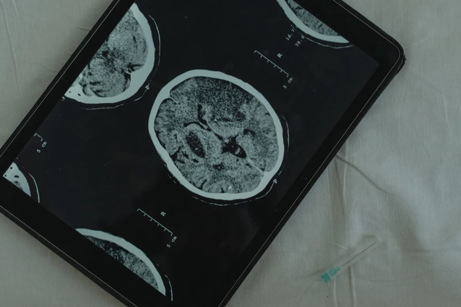 The Stroke Risk That Drives Urgency (Image Credits: Pexels)