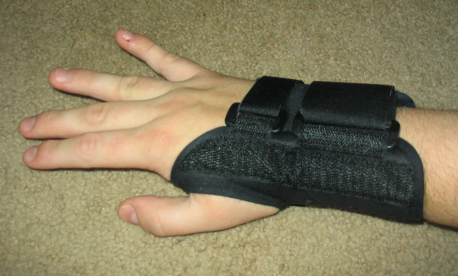 Carpal Tunnel Syndrome: The Most Well-Known Medical Cause (By SPUI, Public domain)