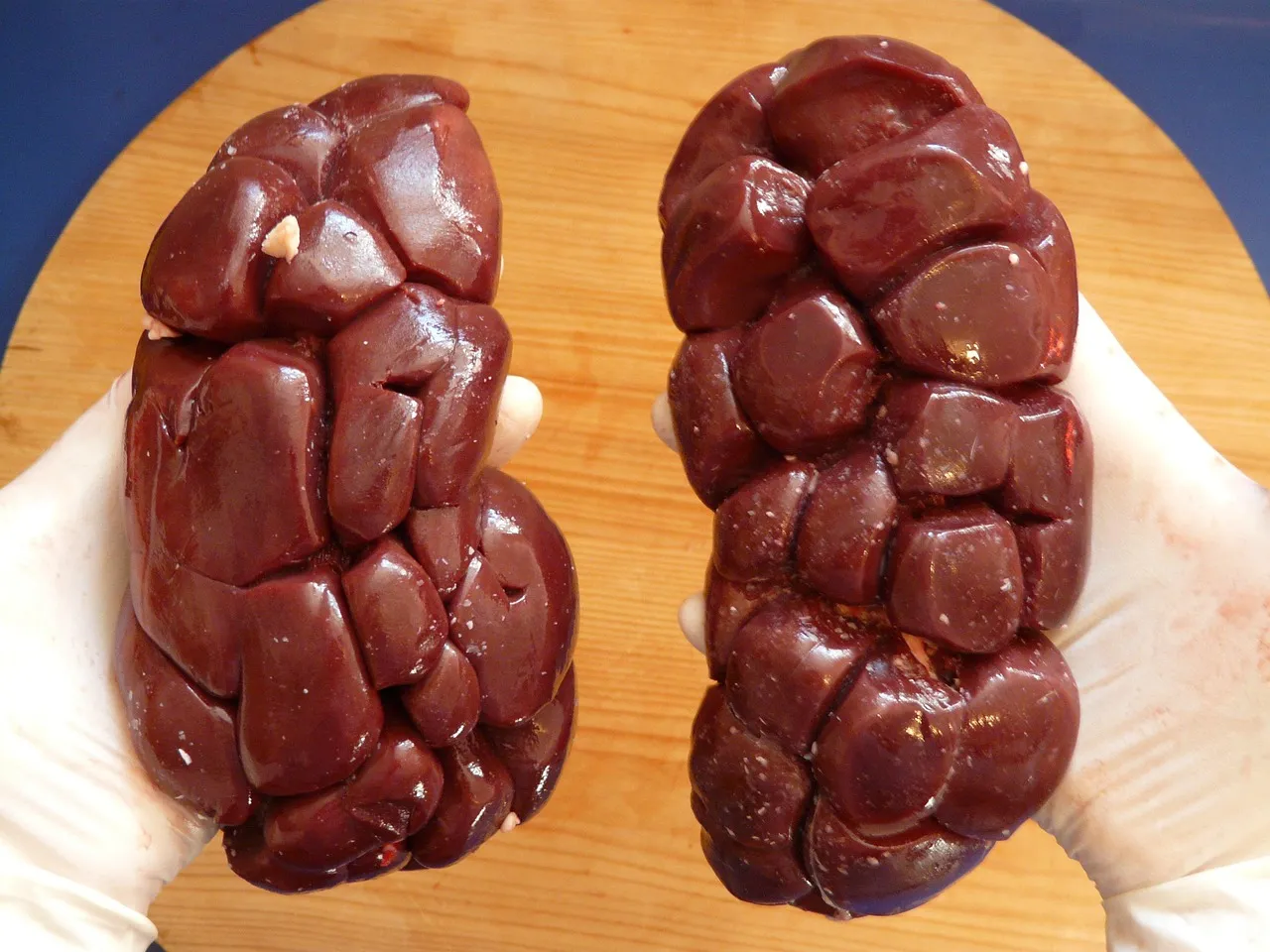 A Word of Caution for Those With Kidney Disease (Image Credits: Pixabay)