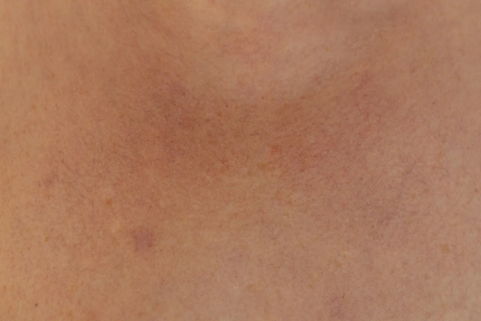 Toasted Skin Syndrome: The Condition Nobody Talks About (Image Credits: Unsplash)