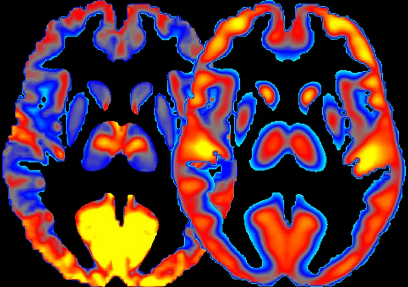 Voluntary vs. Involuntary Recall: Different Brain Pathways (Brain Activity and Glucose Consumption, Public domain)