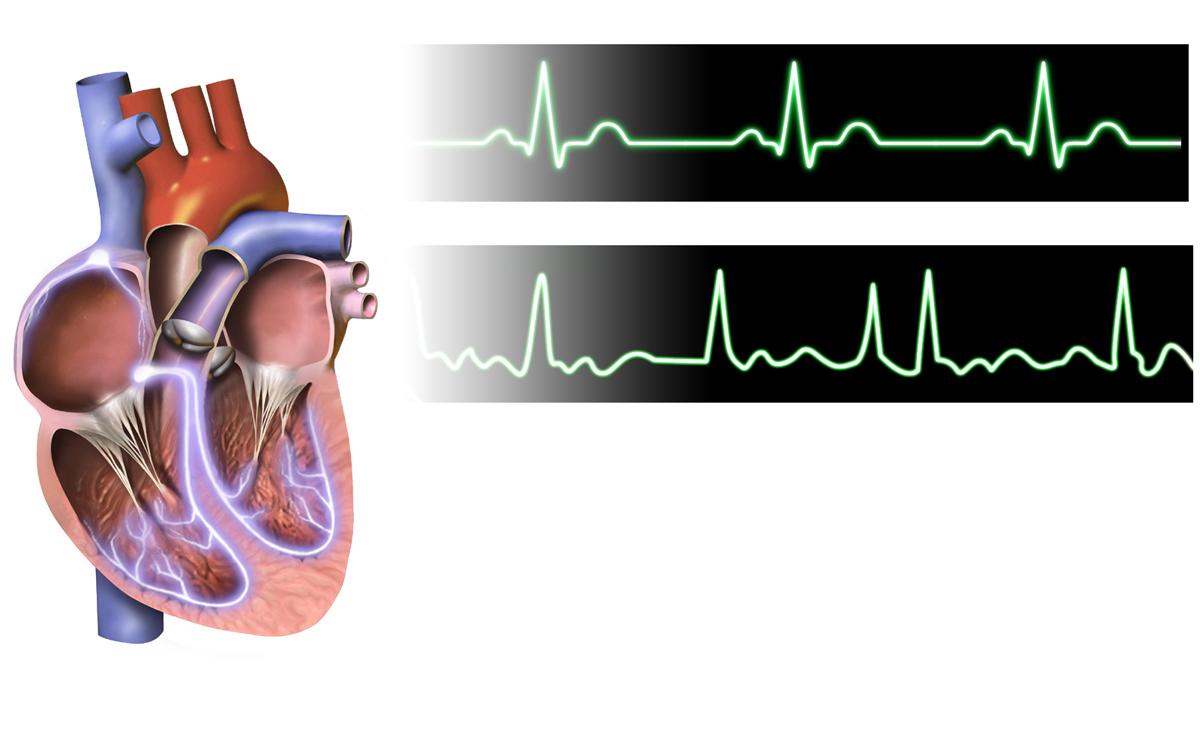 Atrial Fibrillation Detection (image credits: By BruceBlaus, CC BY-SA 4.0, https://commons.wikimedia.org/w/index.php?curid=56628328)